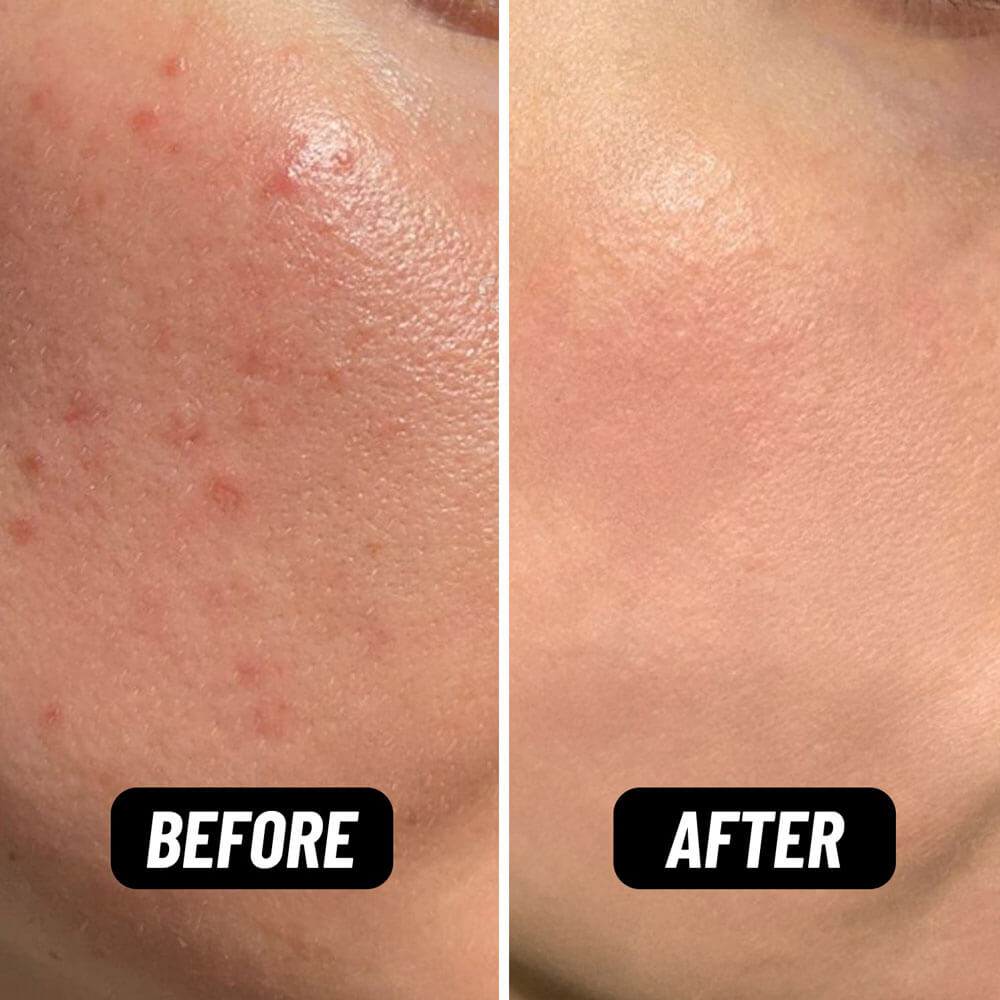 Before and after comparison of skin with acne treatment